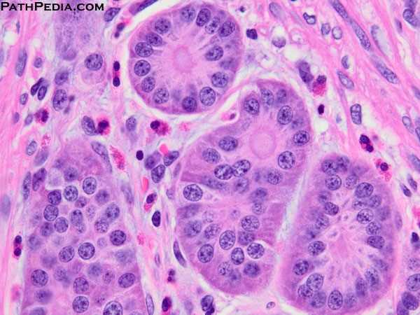 ileal-carcinoid-neuroendocrine-tumor-intestine-il007-5
